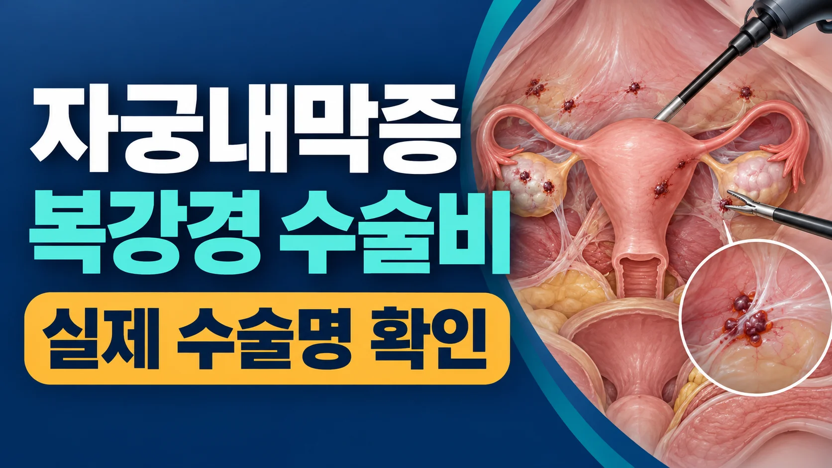 자궁내막증 복강경 수술비와 실제 수술명 확인 카드뉴스