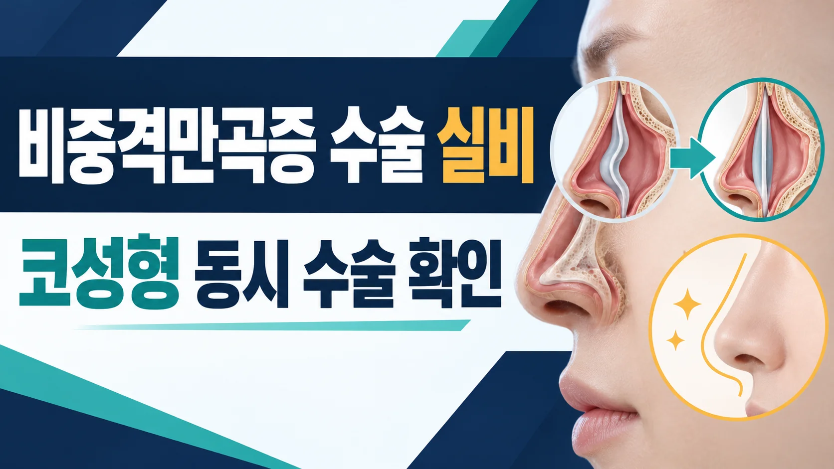 비중격만곡증 수술 실비와 코성형 동시수술 확인 카드뉴스