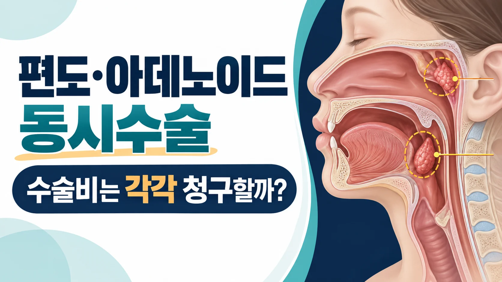 편도와 아데노이드 동시수술의 수술비 확인 카드뉴스